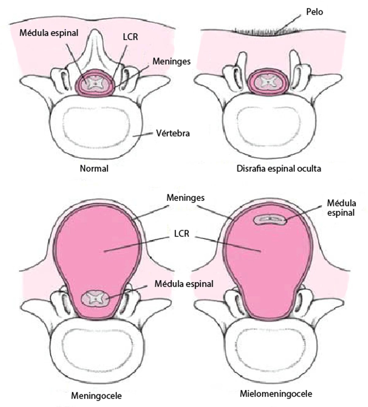 Formas de espina bífida