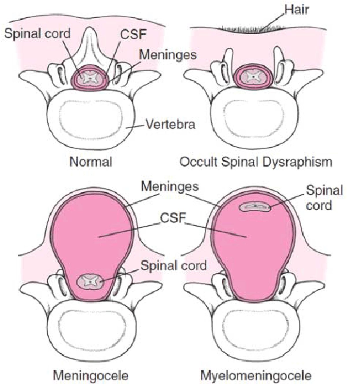 Formes de spina bifida