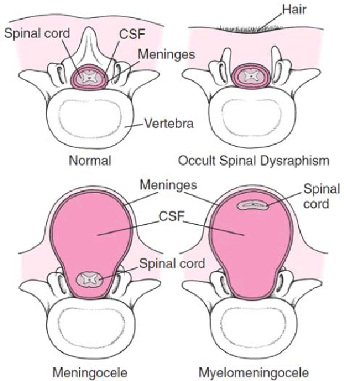 Forme di spina bifida