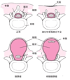 二分脊椎の病型