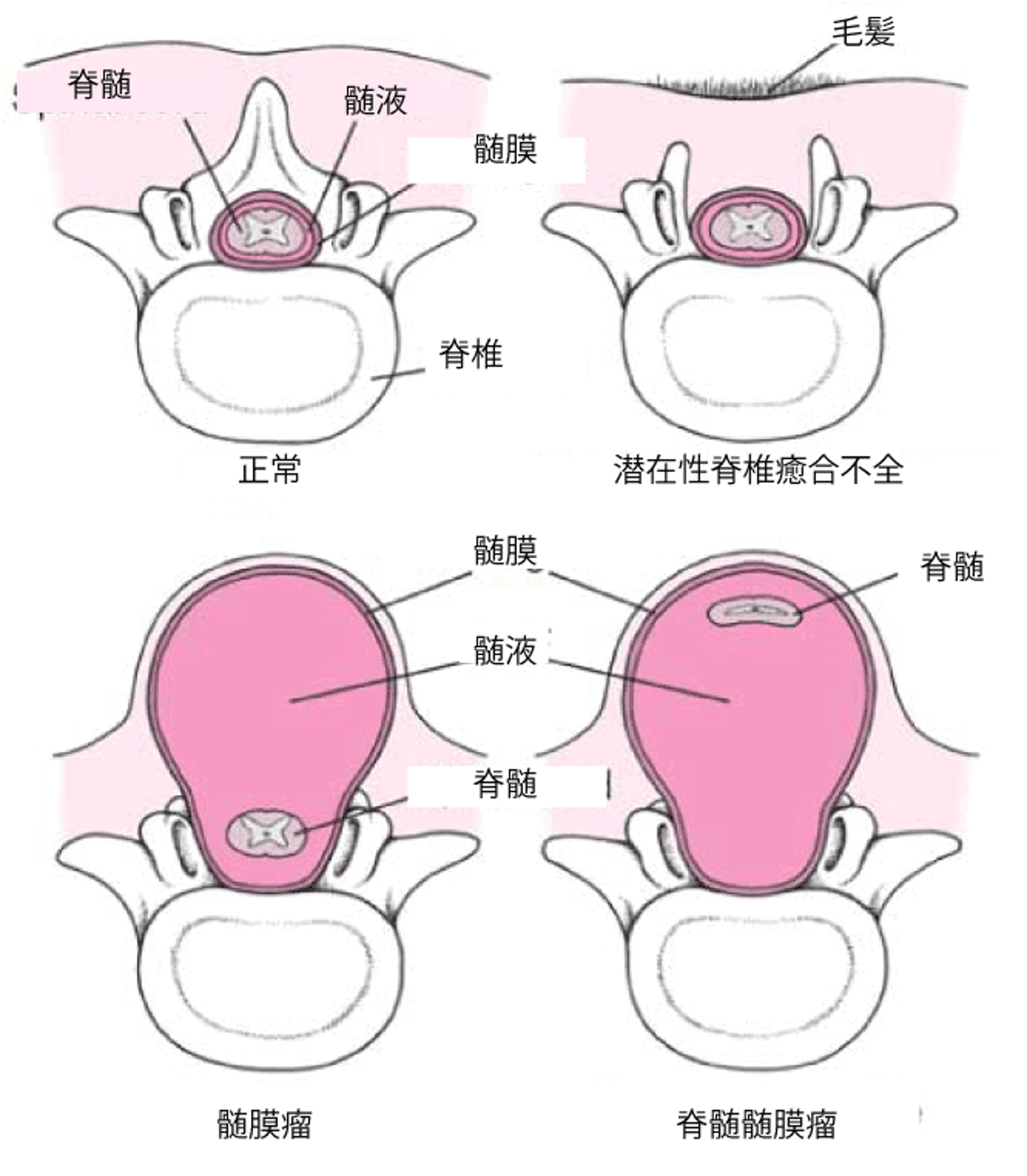 二分脊椎の病型