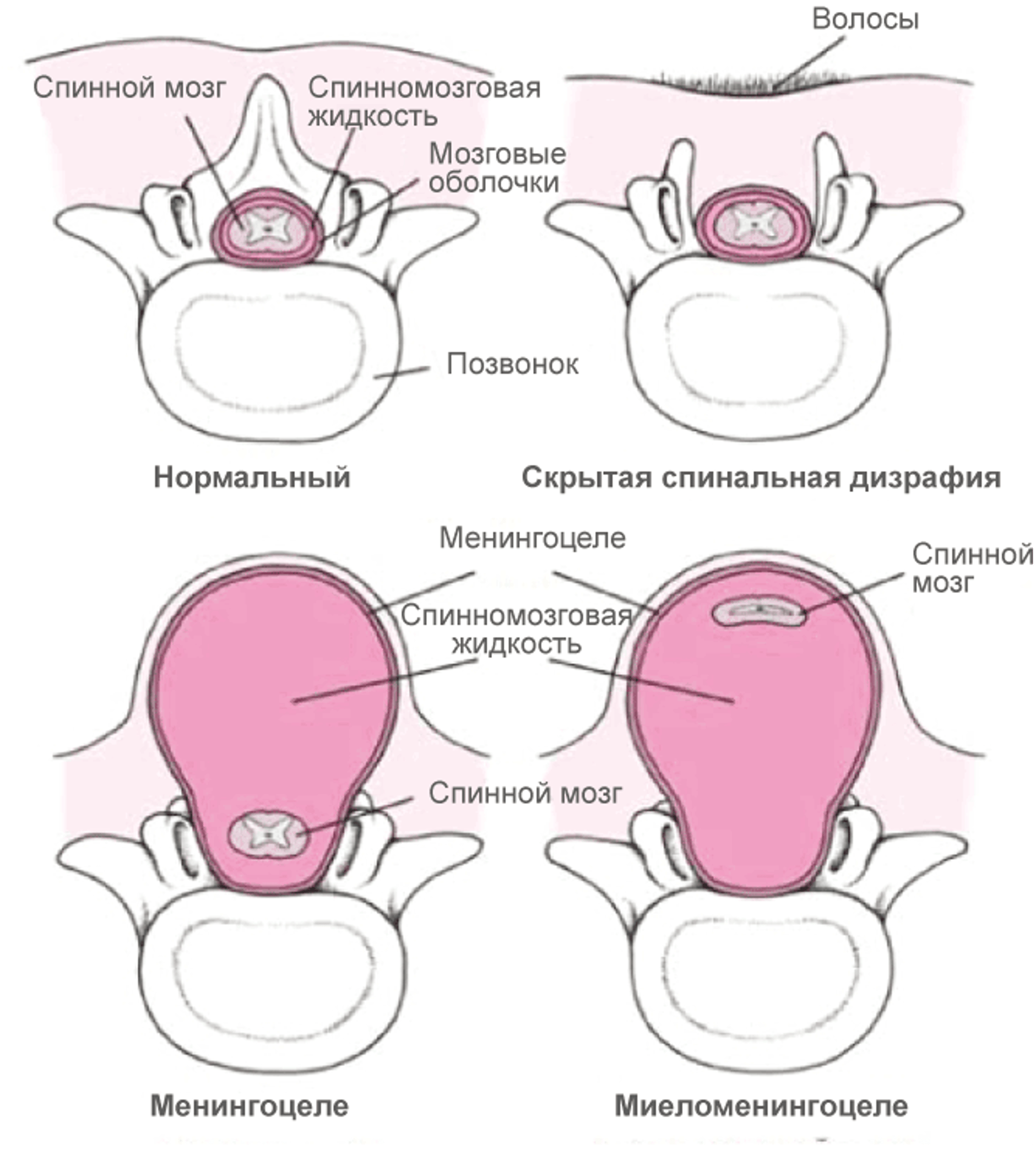 Формы расщелина позвоночника