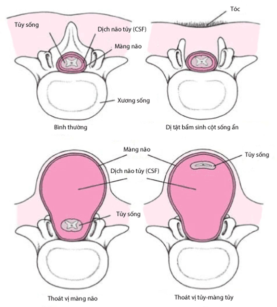 Các dạng nứt đốt sống.