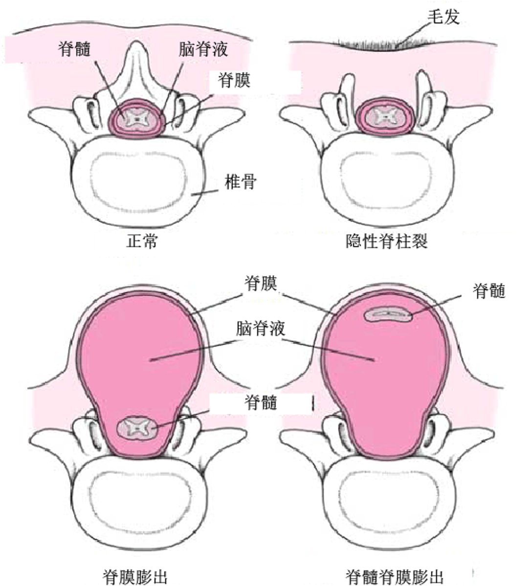 脊柱裂的形式