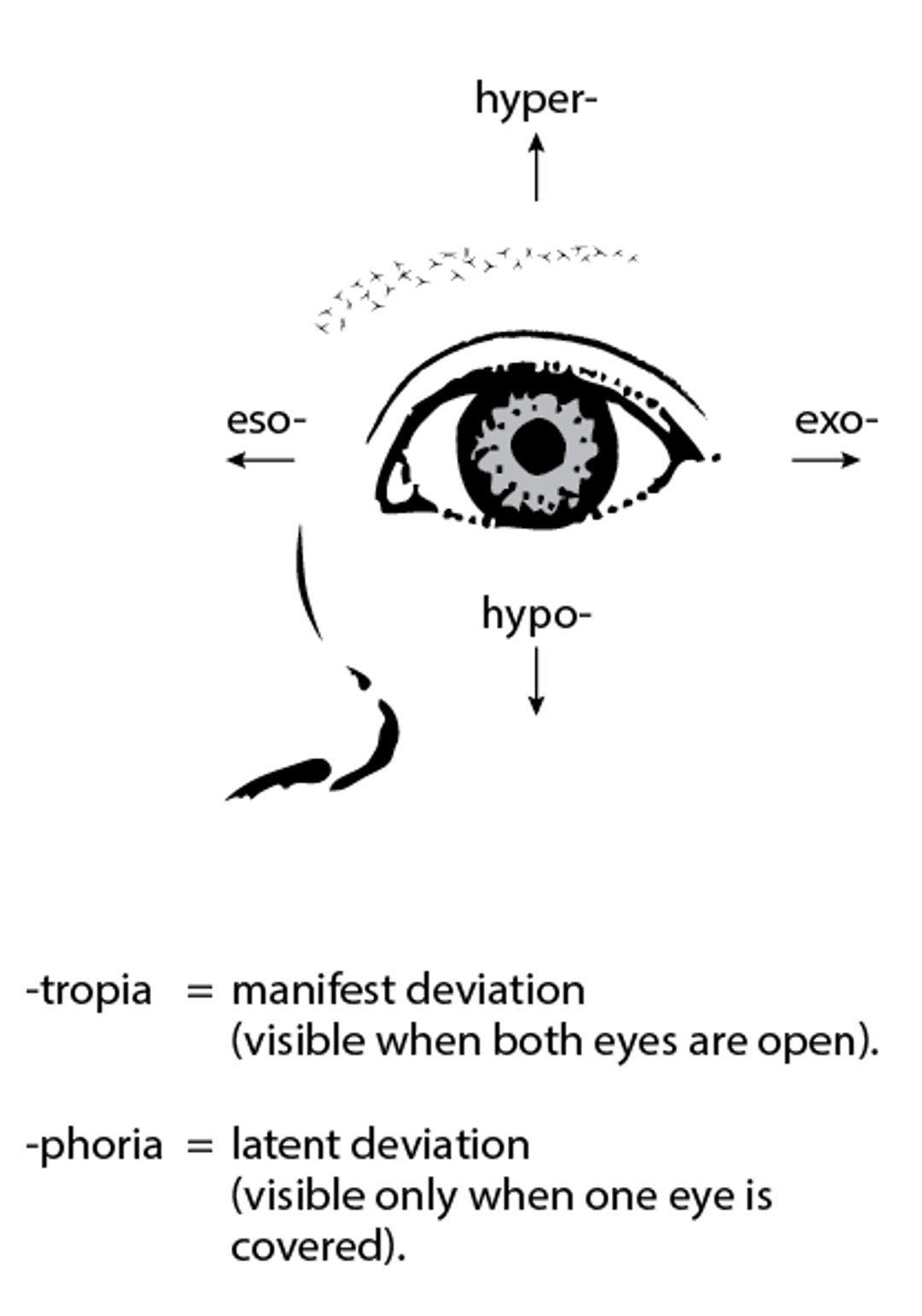 Image:Ocular Deviations in Strabismus-MSD Manual Professional Edition