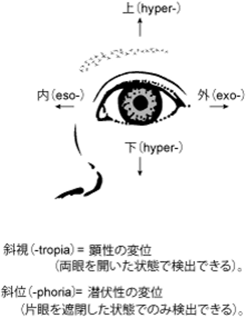 斜視における眼球偏位