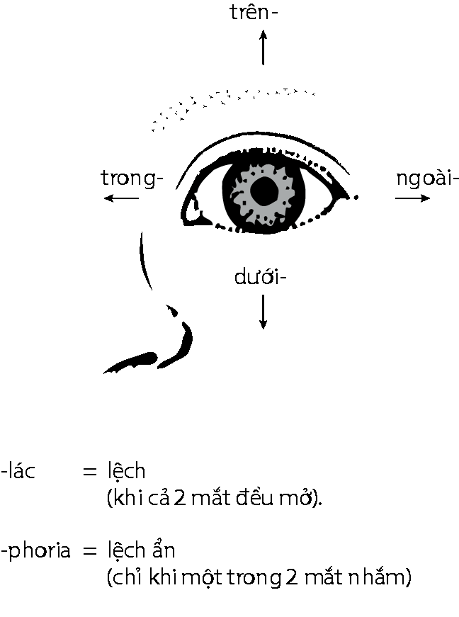 Sự lệch trục mắt trong mắt lác
