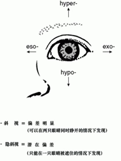斜视眼部偏差