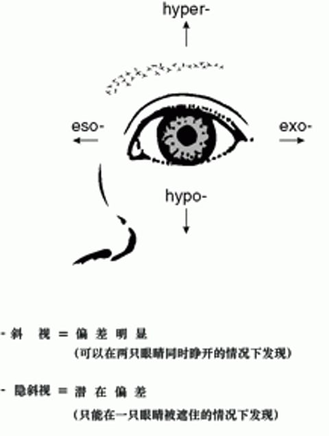 斜视眼部偏差