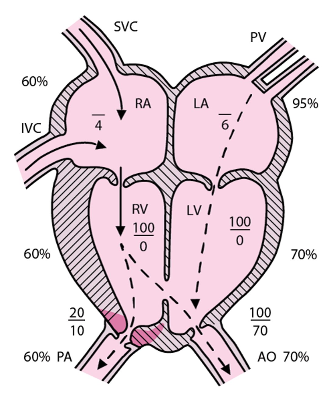 Tetralogia di Fallot