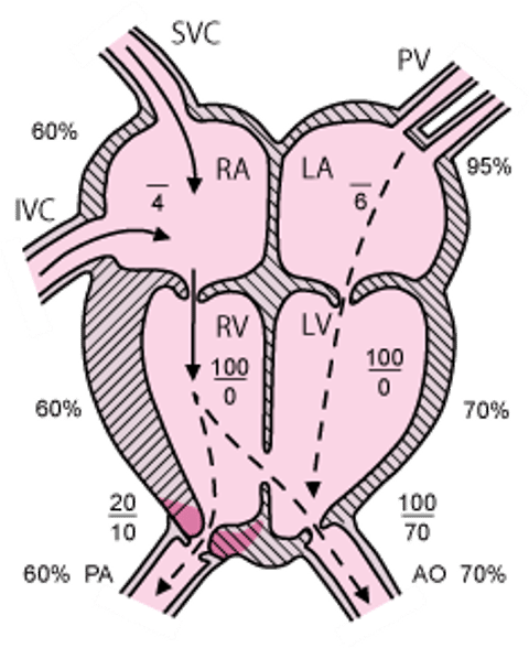 ファロー四徴症