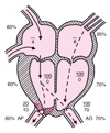 Tetralogia de Fallot