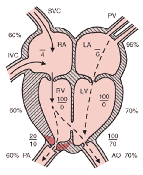 Tetralogia de Fallot