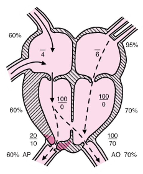 Tetralogia de Fallot