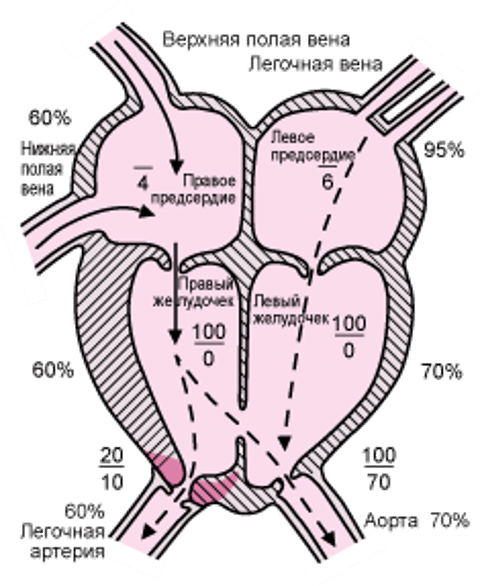 Тетрада Фалло