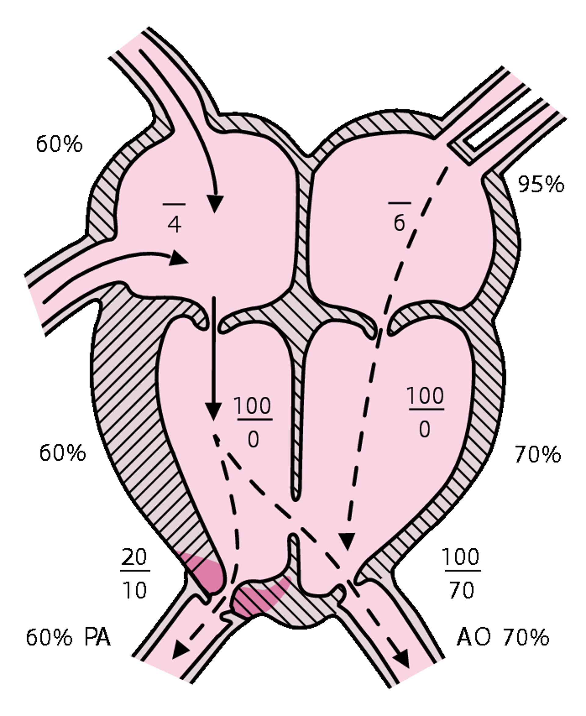 Tứ chứng Fallot