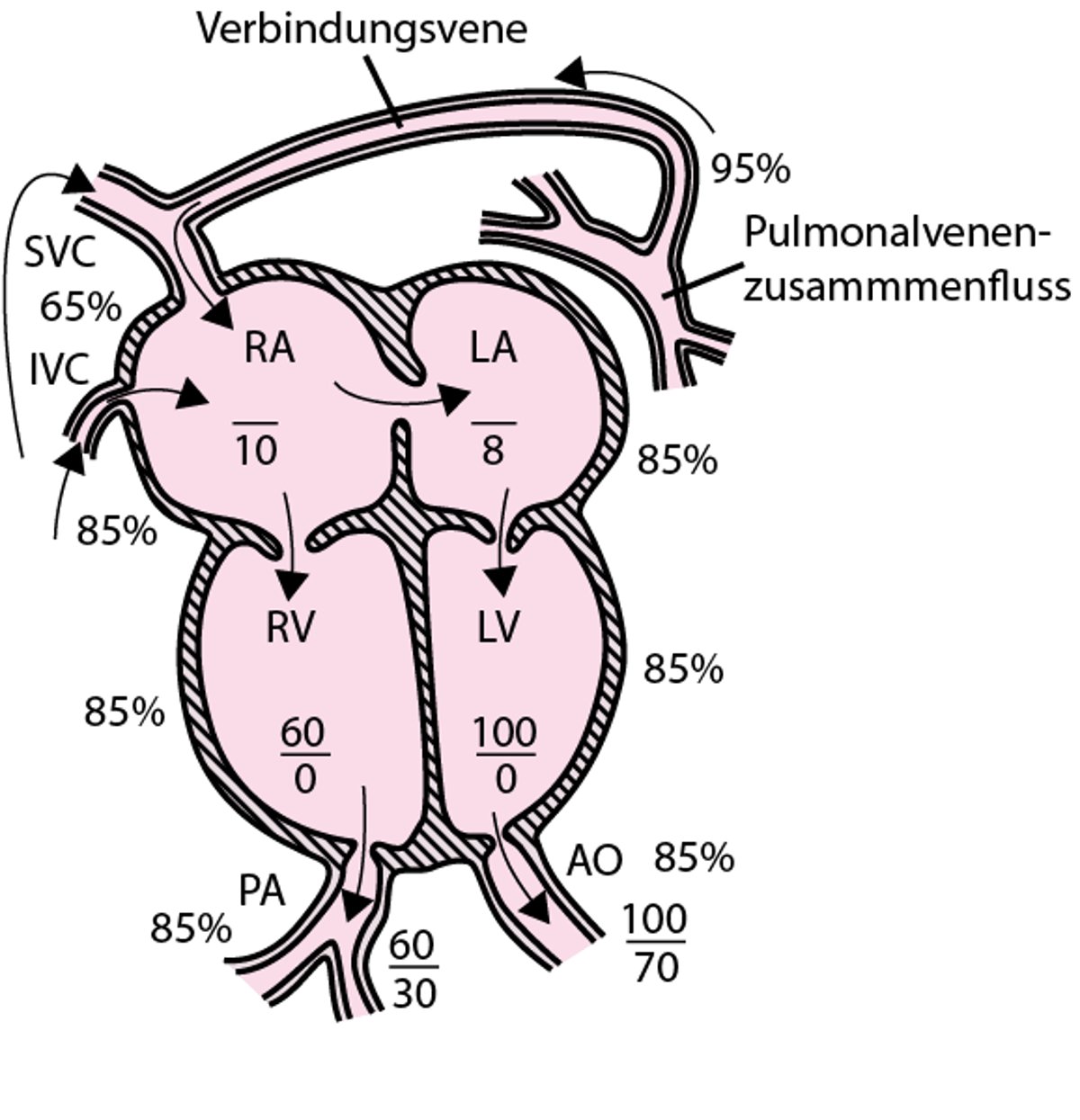 Vollständig anormaler Pulmonalvenenrückfluss