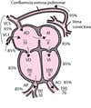 Anomalía total del retorno venoso pulmonar