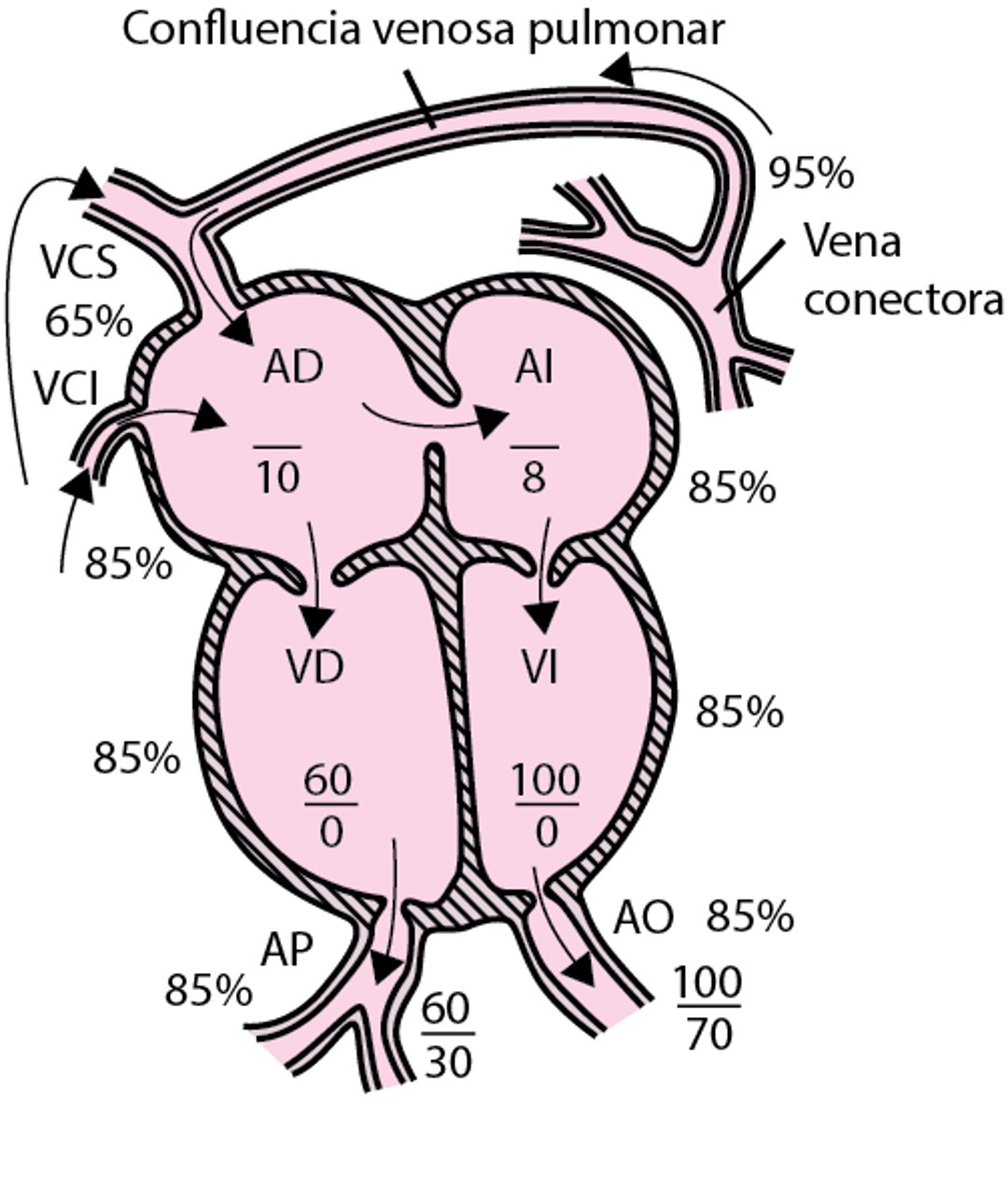 Anomalía total del retorno venoso pulmonar