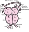 Retour veineux pulmonaire anormal total