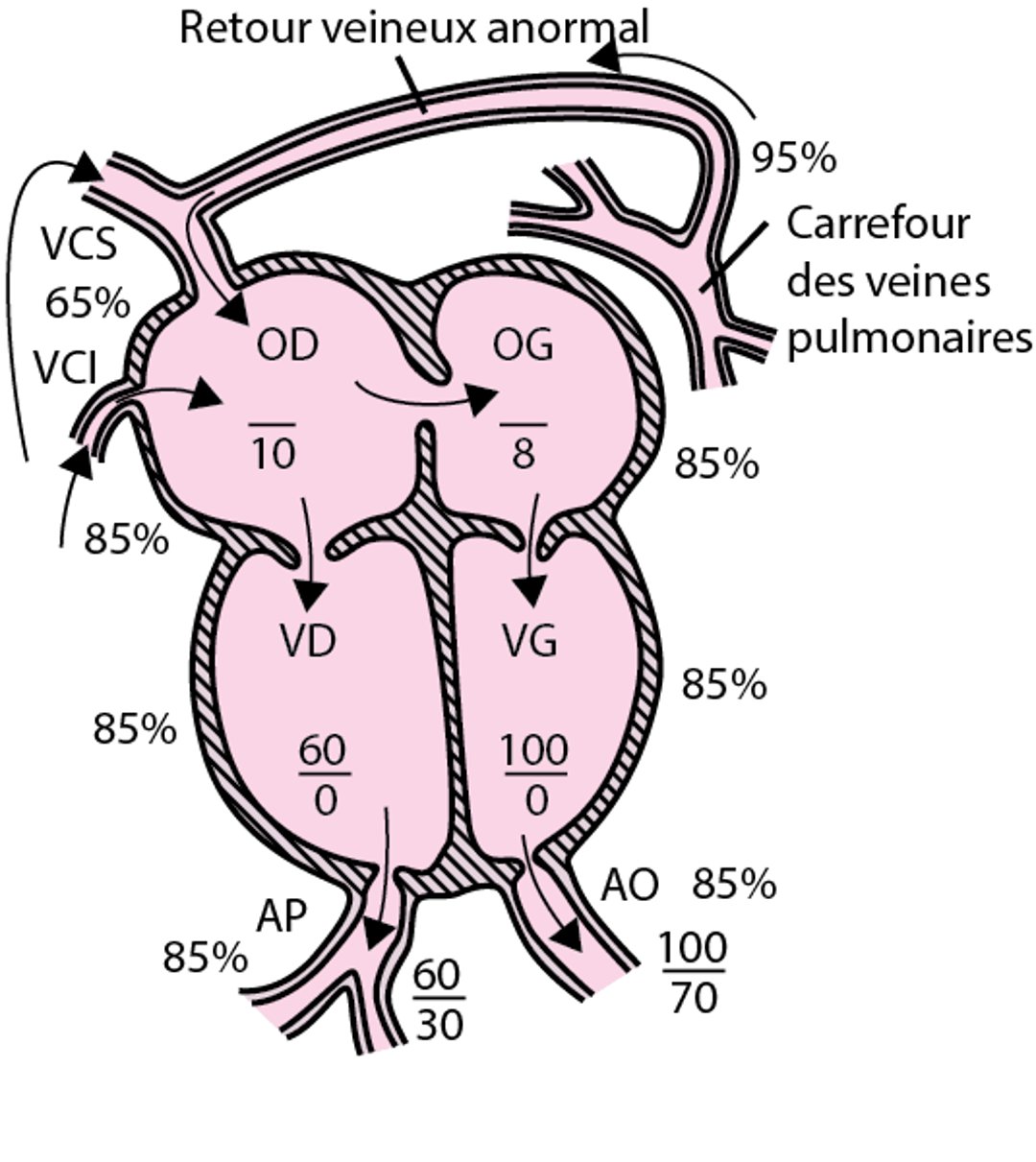 Retour veineux pulmonaire anormal total