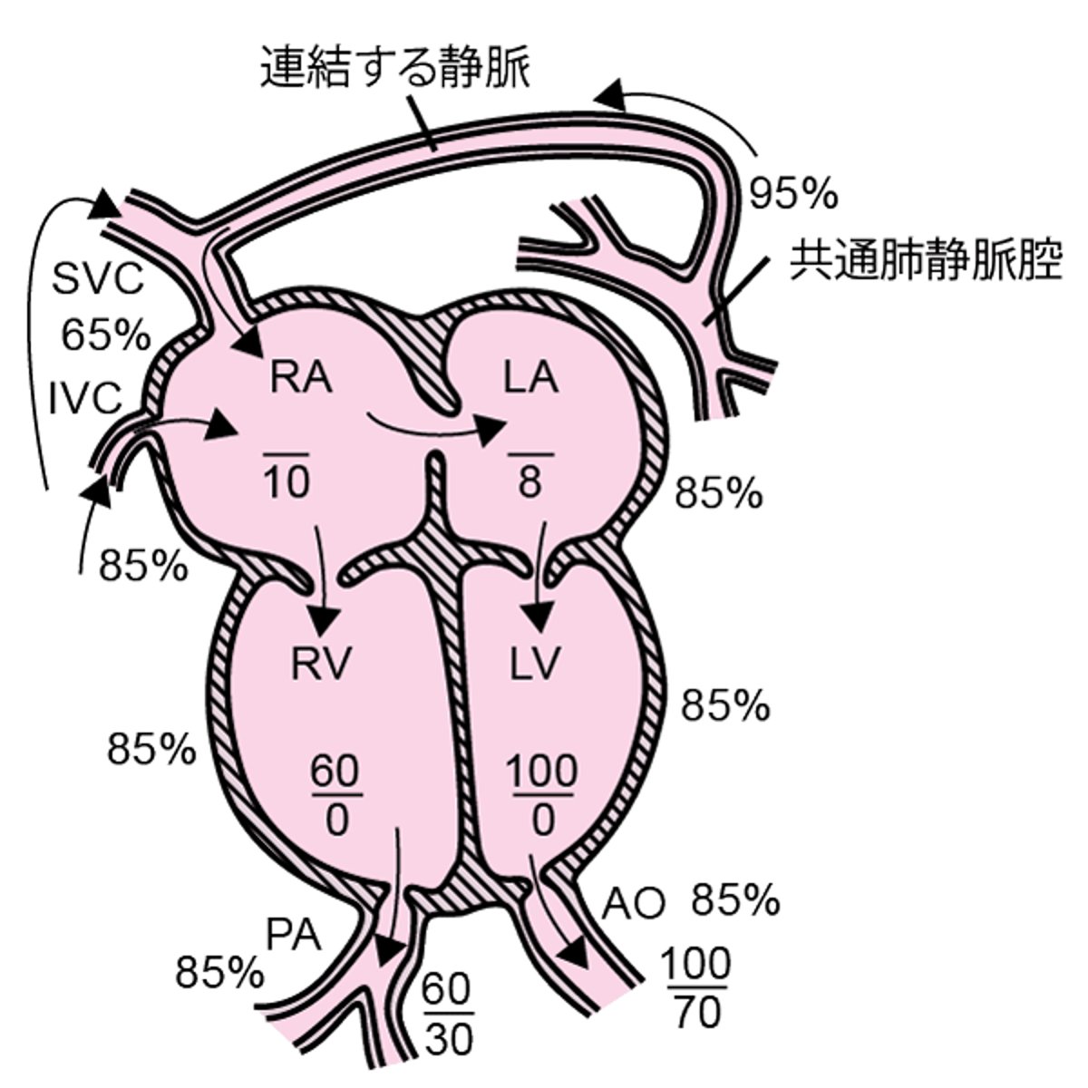 総肺静脈還流異常症