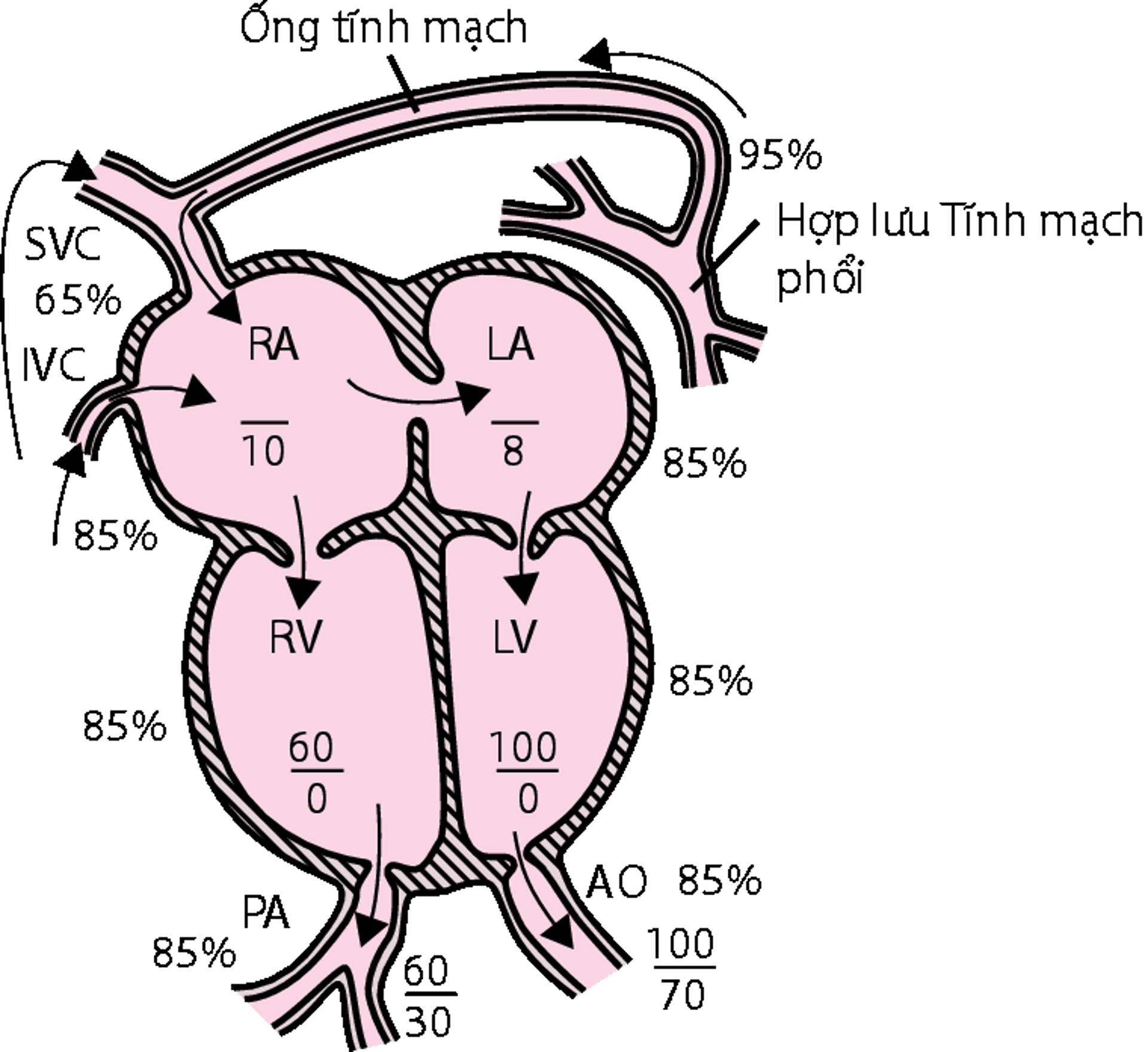 Bất thường tĩnh mạch phổi trở về hoàn toàn (TAPVR)