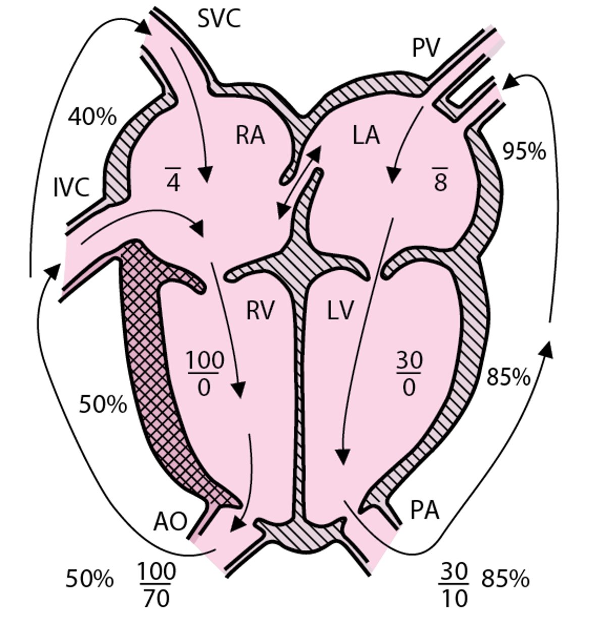 Dextro-transposition of the great arteries