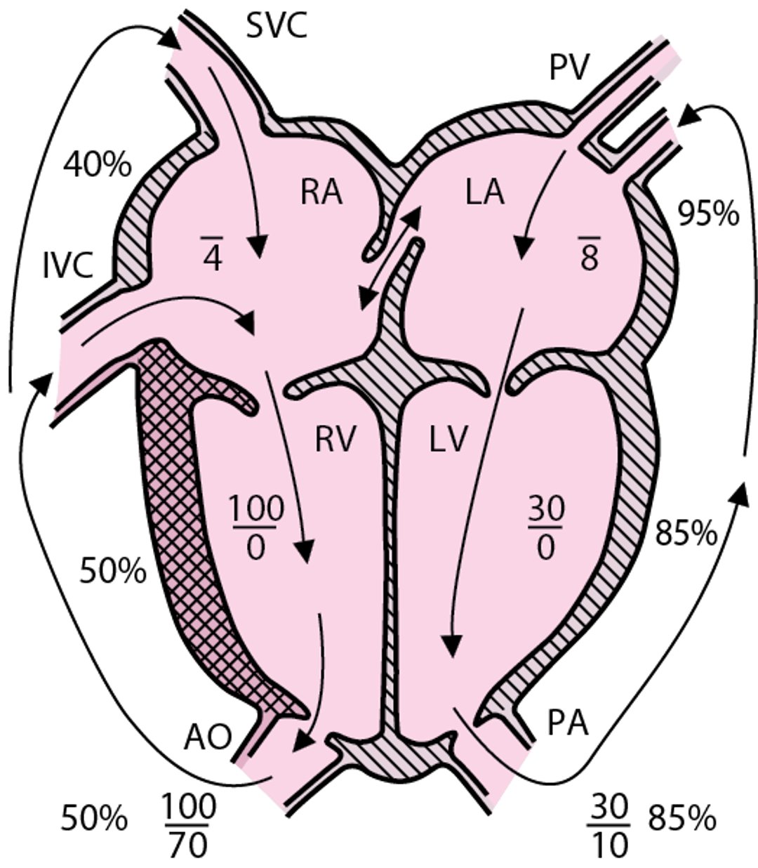 Dextro-trasposizione delle grandi arterie