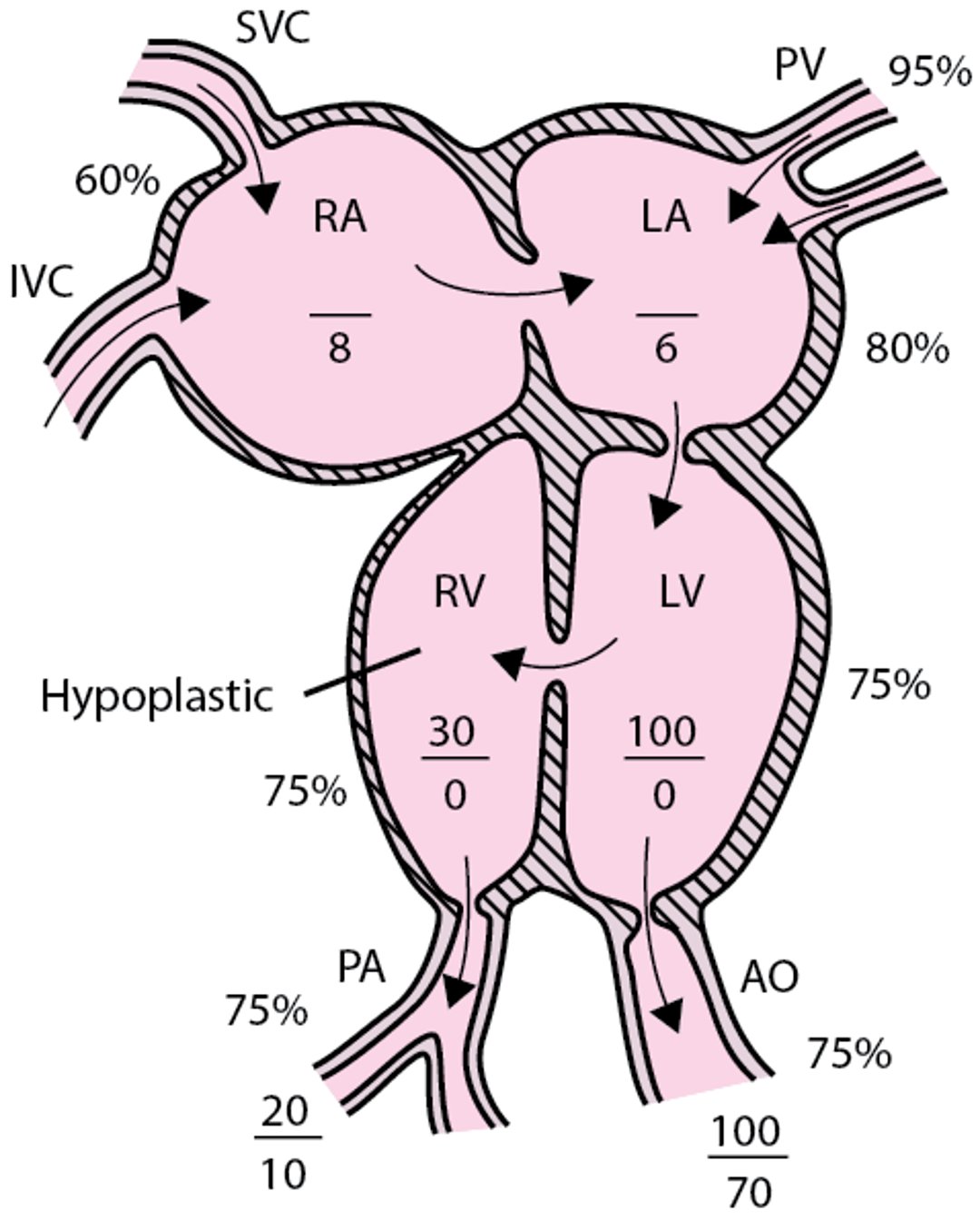 Tricuspid atresia with normally related great vessels