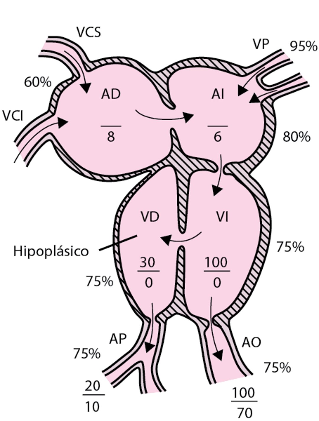 Atresia tricúspidea con grandes vasos normalmente relacionados