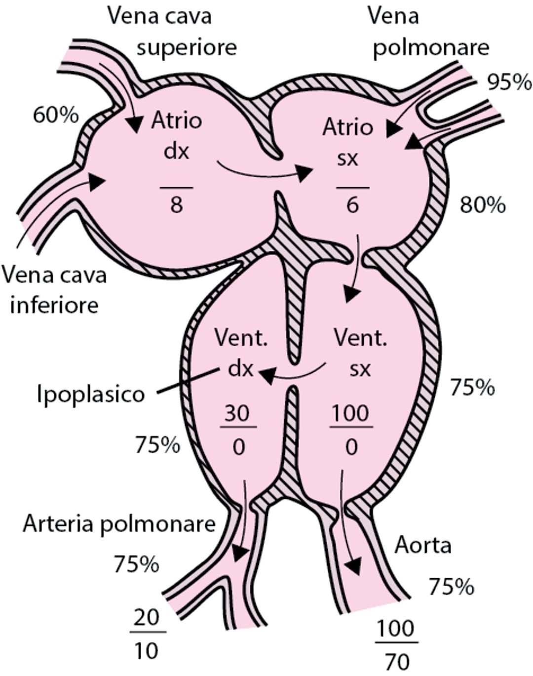 Atresia tricuspidale con grandi vasi normali