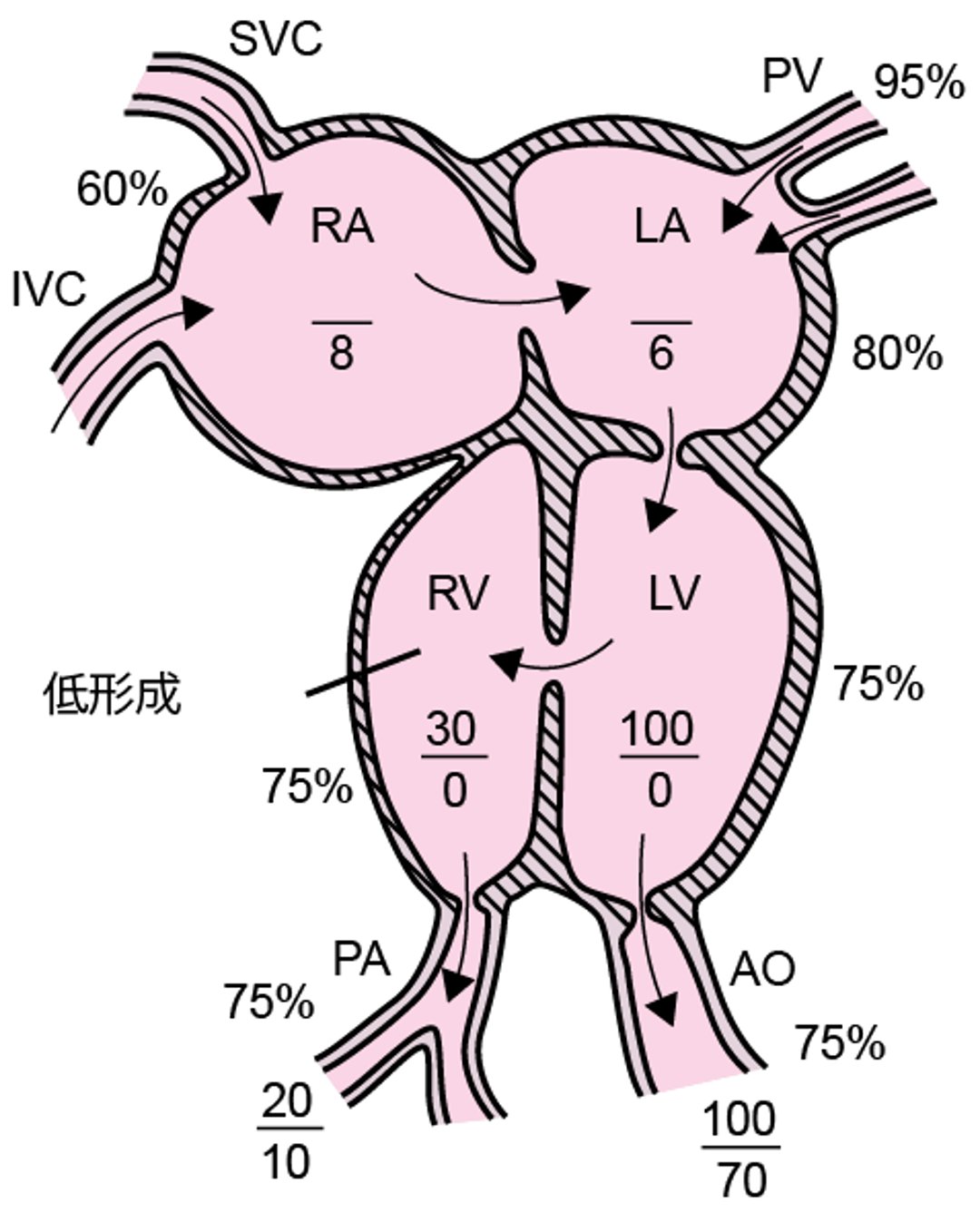 大血管転位を伴わない三尖弁閉鎖症