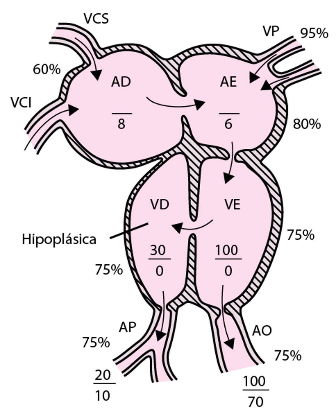 Atresia tricúspide com grandes vasos normalmente associados