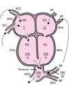 Truncus arteriosus (tronc artériel commun)