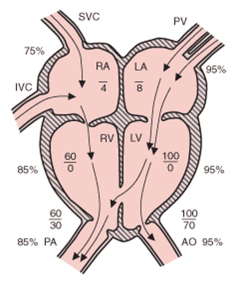 Ventricular septal defect