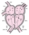 Ventrikelseptumdefekt