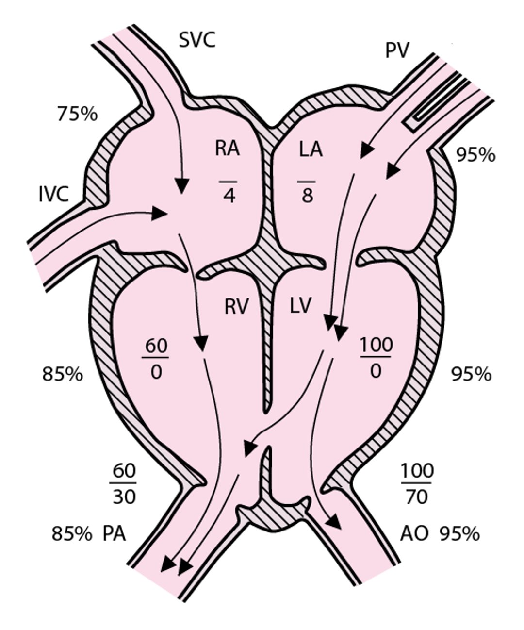 Ventrikelseptumdefekt
