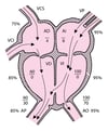 Comunicación interventricular