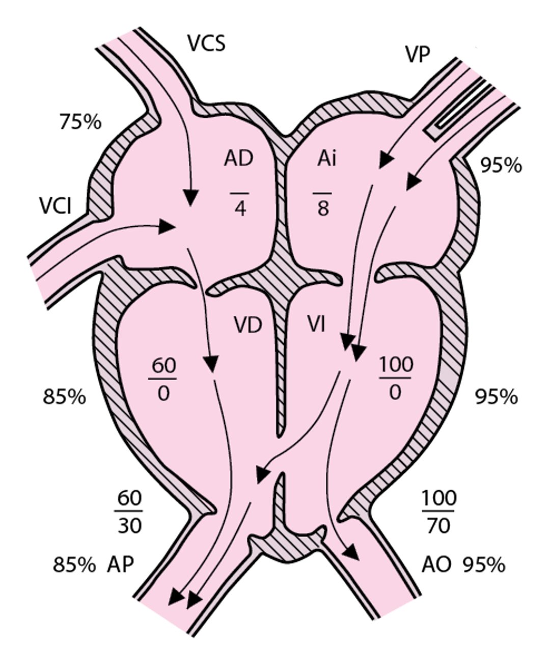 Comunicación interventricular