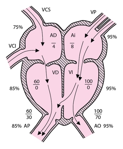Comunicación interventricular