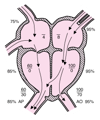 Defeito do septo ventricular