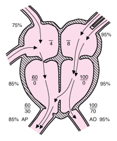 Defeito do septo ventricular