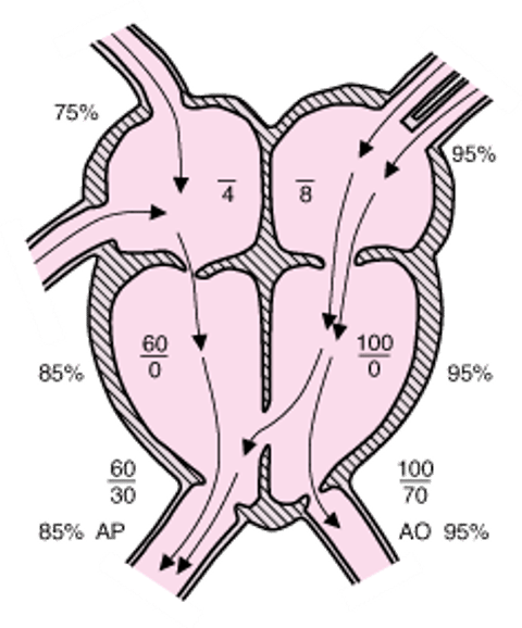 Defeito do septo ventricular