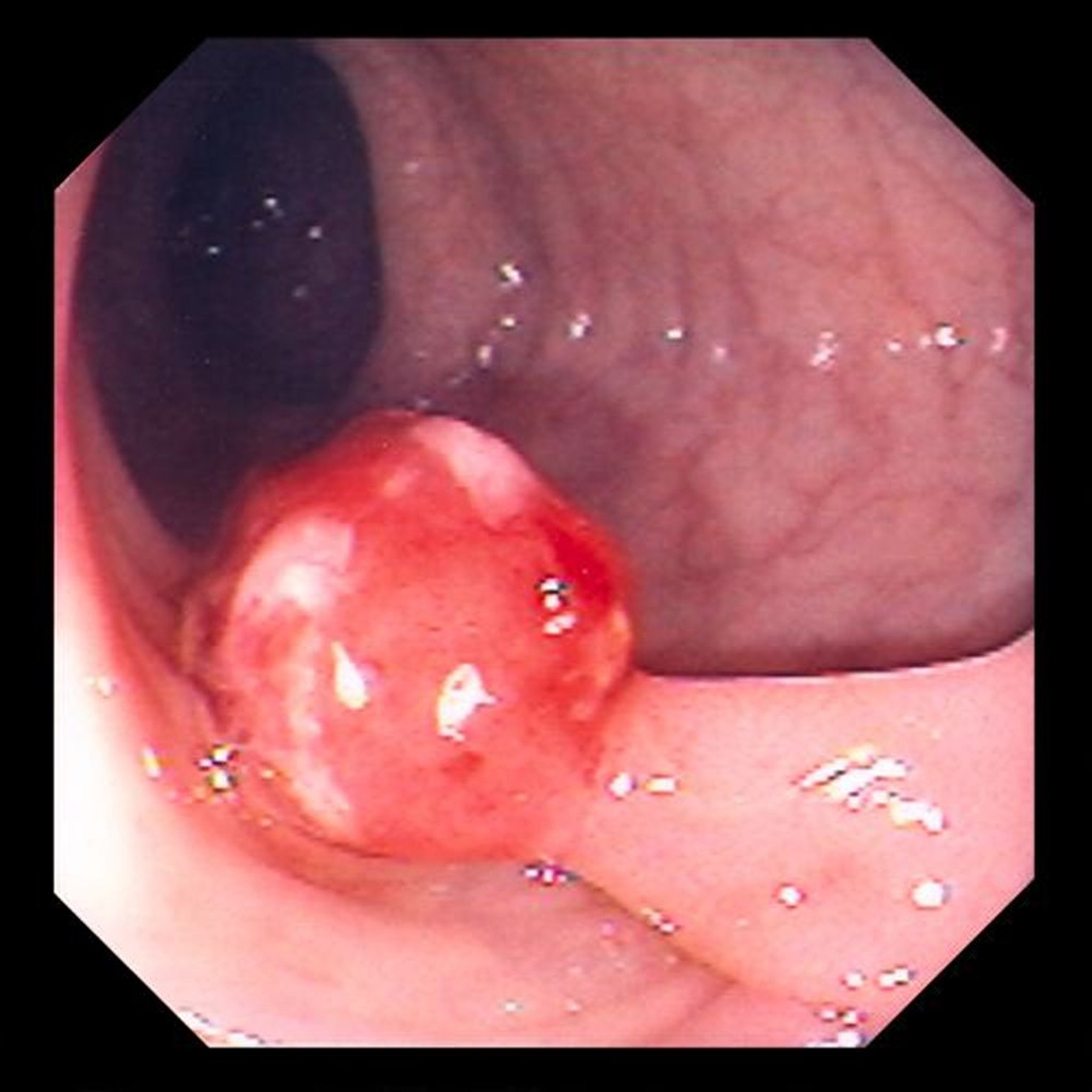 Polyp có cuống