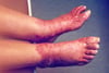 Pellagrous Skin Changes (Feet)