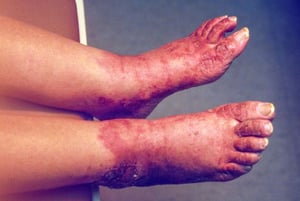 Anomalies cutanées pellagreuses (pieds)