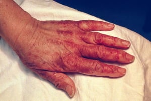 Pellagöse Hautveränderungen (Hand)