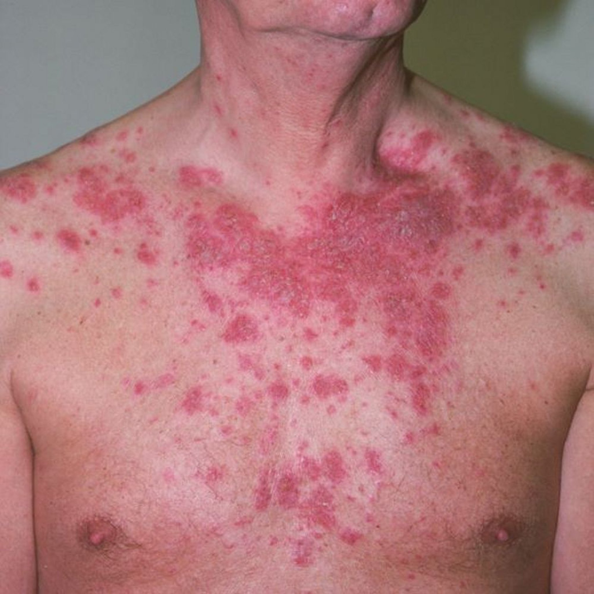 Pemphigus foliacé (thorax)