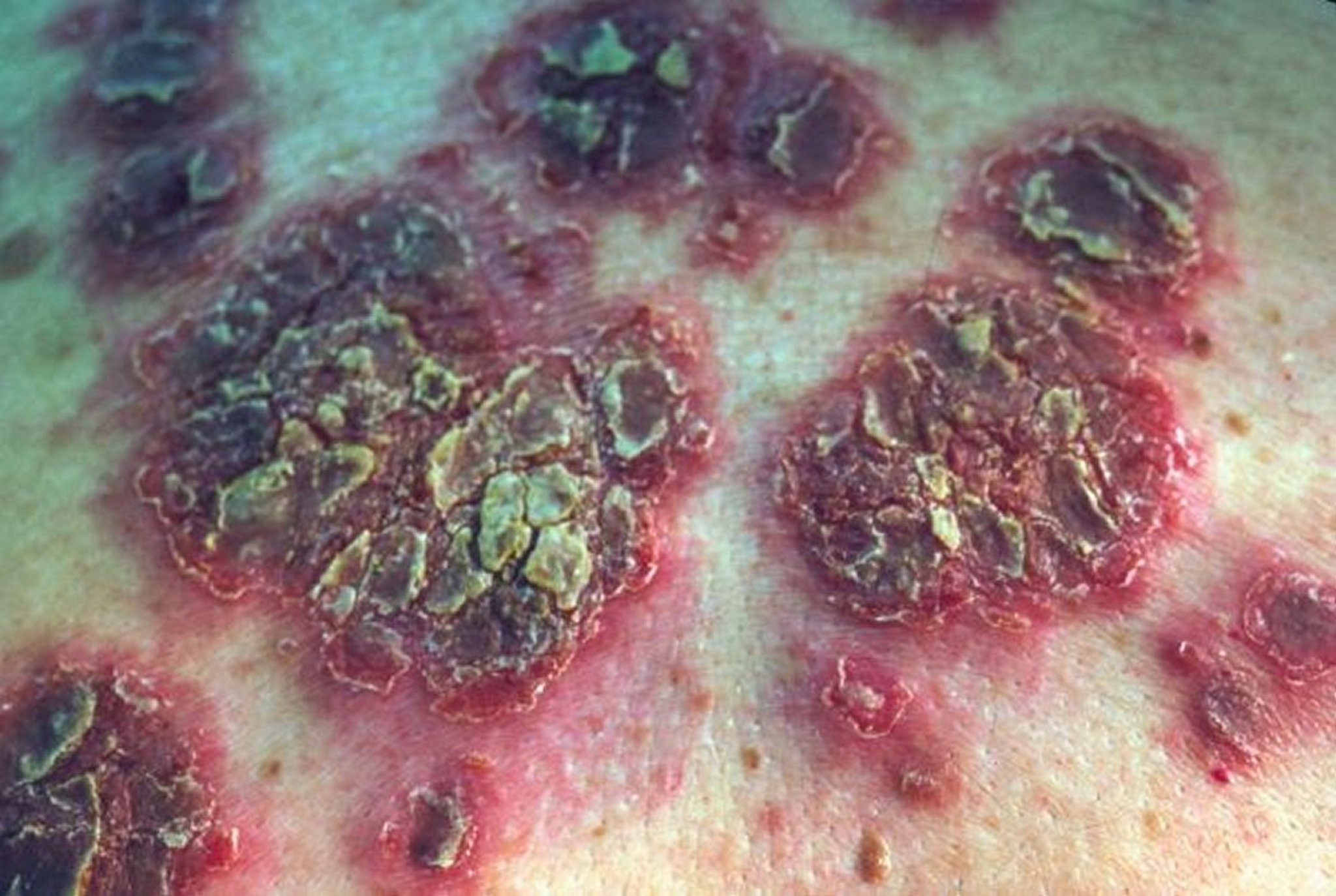 Pemphigus Foliaceus